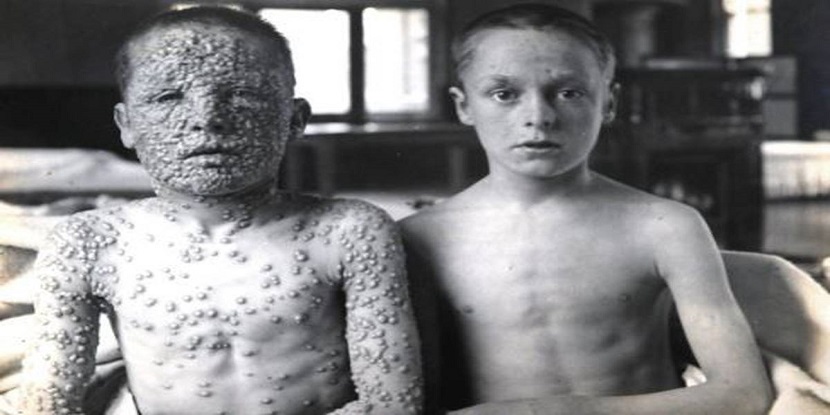 smallpox