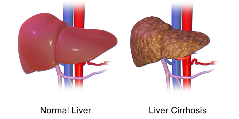 Cirrhosis