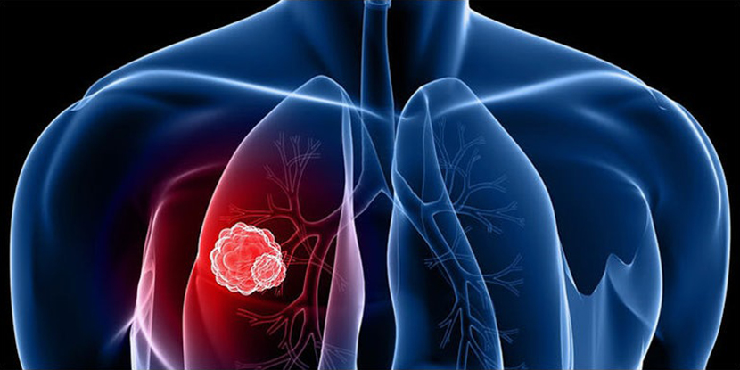 Lung Cancer