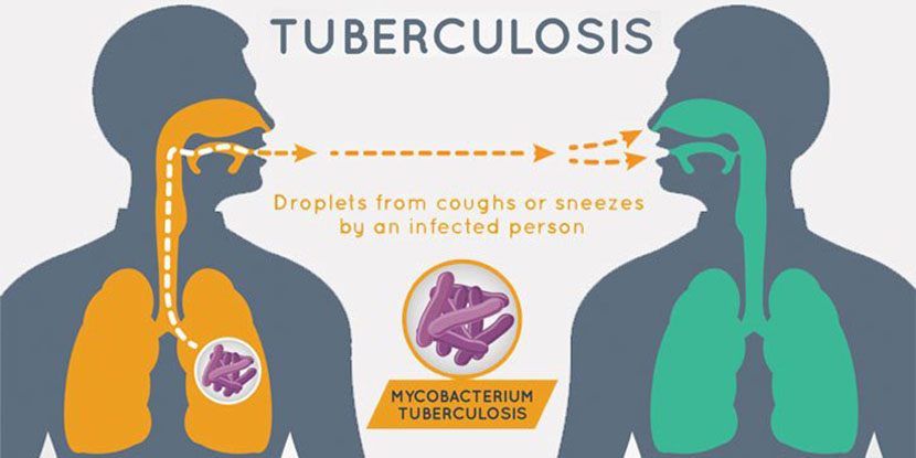 Tuberculosis