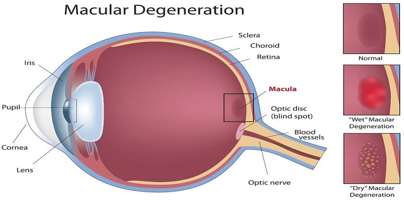 macular degeneration