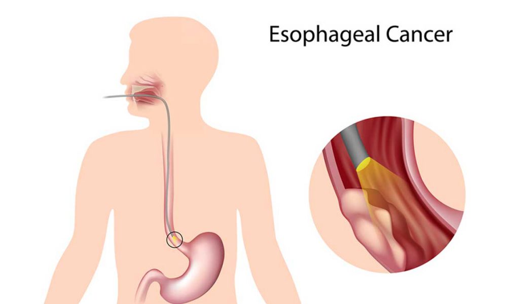 esophageal cancer