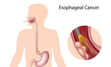 esophageal cancer