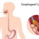 esophageal cancer