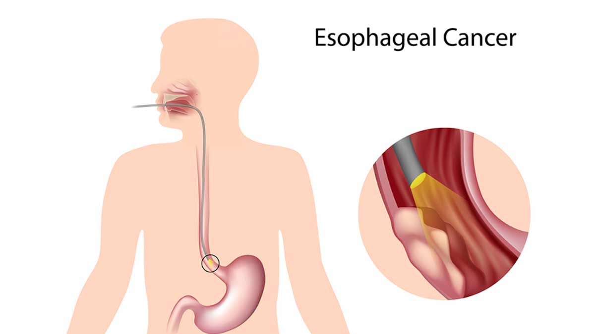 esophageal cancer