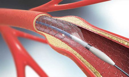 stroke stent