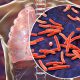 tuberculosis