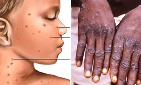 monkeypox high alert