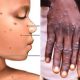 monkeypox high alert