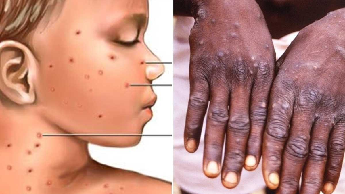 monkeypox high alert