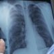 More Than 600,000 People Have Contracted Tuberculosis in Pakis