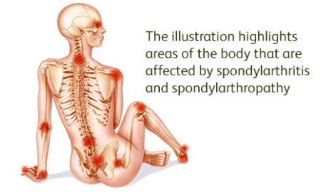 Axial Spondyloarthritis