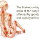 Axial Spondyloarthritis