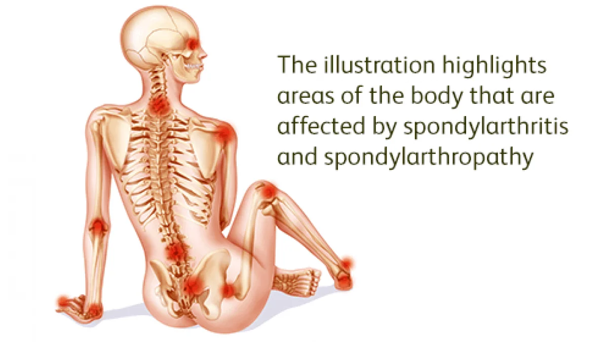 Axial Spondyloarthritis